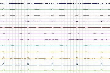 Electrocardiogram for PTB Diagnostic ECG, record s0548_re-patient287