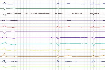 Electrocardiogram for PTB Diagnostic ECG, record s0549_re-patient288