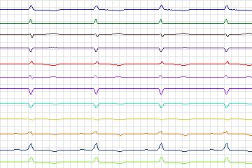 Electrocardiogram for PTB Diagnostic ECG, record s0550_re-patient289
