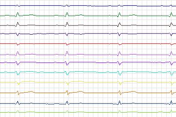 Electrocardiogram for PTB Diagnostic ECG, record s0551_re-patient284