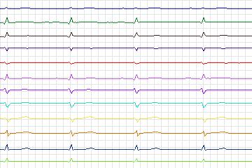 Electrocardiogram for PTB Diagnostic ECG, record s0552_re-patient284