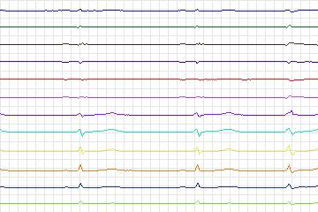 Electrocardiogram for PTB Diagnostic ECG, record s0553_re-patient290