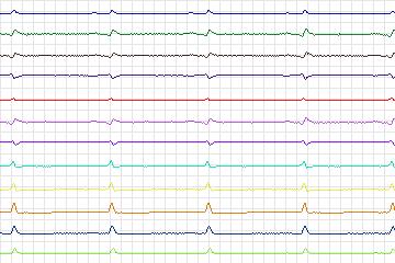 Electrocardiogram for PTB Diagnostic ECG, record s0554_re-patient291