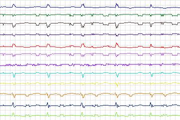 Electrocardiogram for PTB Diagnostic ECG, record s0555_re-patient292