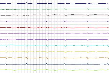 Electrocardiogram for PTB Diagnostic ECG, record s0556_re-patient292
