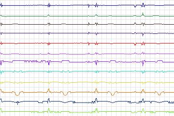 Electrocardiogram for PTB Diagnostic ECG, record s0557_re-patient293