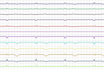 Electrocardiogram for PTB Diagnostic ECG, record s0558_re-patient293