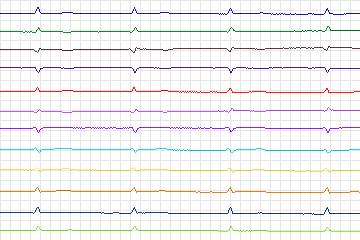 Electrocardiogram for PTB Diagnostic ECG, record s0559_re-patient294