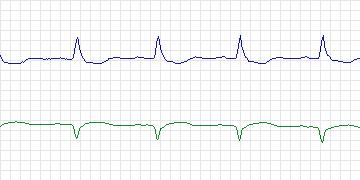 Electrocardiogram for QT, record sel48