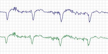 Electrocardiogram for Sudden Cardiac Death Holter, record 40