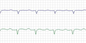 Electrocardiogram for Sudden Cardiac Death Holter, record 41