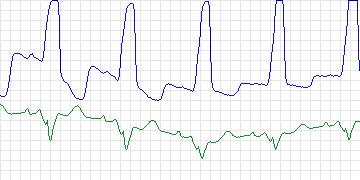 Electrocardiogram for Sudden Cardiac Death Holter, record 42