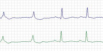 Electrocardiogram for Sudden Cardiac Death Holter, record 44