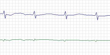 Electrocardiogram for Sudden Cardiac Death Holter, record 45