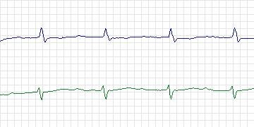 Electrocardiogram for Sudden Cardiac Death Holter, record 46