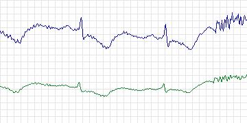 Electrocardiogram for Sudden Cardiac Death Holter, record 47