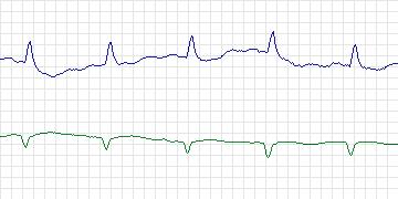 Electrocardiogram for Sudden Cardiac Death Holter, record 48