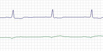 Electrocardiogram for Sudden Cardiac Death Holter, record 49
