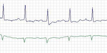 Electrocardiogram for Sudden Cardiac Death Holter, record 52
