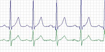 Electrocardiogram for MIT-BIH ST Change, record 310