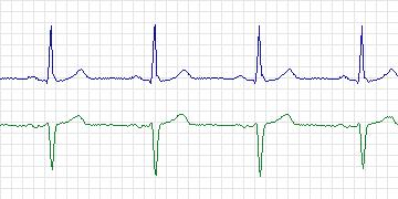 Electrocardiogram for MIT-BIH ST Change, record 311