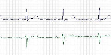 Electrocardiogram for MIT-BIH ST Change, record 312