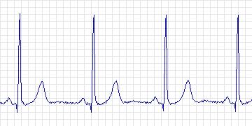 Electrocardiogram for MIT-BIH ST Change, record 313