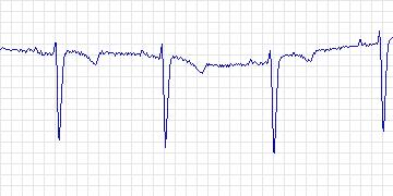 Electrocardiogram for MIT-BIH ST Change, record 315