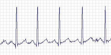 Electrocardiogram for MIT-BIH ST Change, record 316