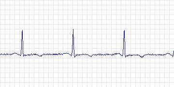Electrocardiogram for MIT-BIH ST Change, record 317