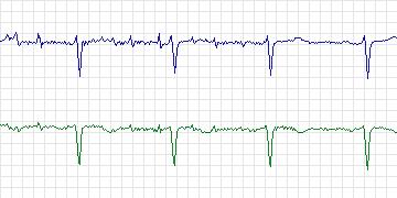 Electrocardiogram for MIT-BIH ST Change, record 318