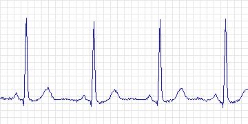 Electrocardiogram for MIT-BIH ST Change, record 319