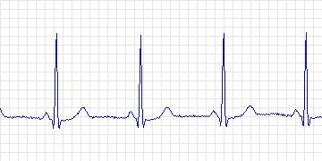 Electrocardiogram for MIT-BIH ST Change, record 320