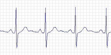 Electrocardiogram for MIT-BIH ST Change, record 321