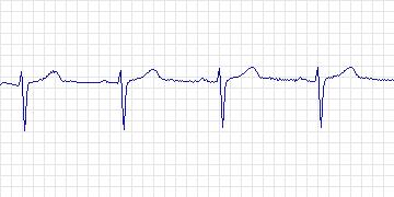 Electrocardiogram for MIT-BIH ST Change, record 323