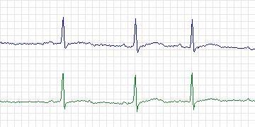 Electrocardiogram for MIT-BIH ST Change, record 324