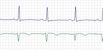 Electrocardiogram for MIT-BIH ST Change, record 325