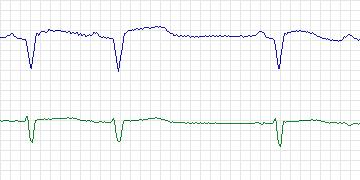Electrocardiogram for MIT-BIH ST Change, record 326