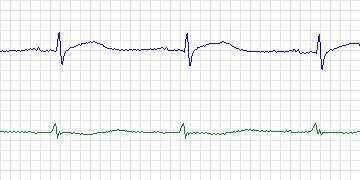Electrocardiogram for MIT-BIH ST Change, record 327