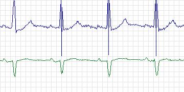 Electrocardiogram for MIT-BIH Supraventricular Arrhythmia, record 807