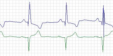 Electrocardiogram for MIT-BIH Supraventricular Arrhythmia, record 808