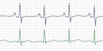 Electrocardiogram for MIT-BIH Supraventricular Arrhythmia, record 809