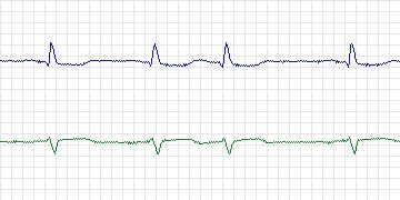 Electrocardiogram for MIT-BIH Supraventricular Arrhythmia, record 820