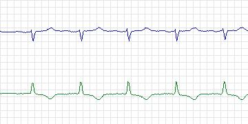 Electrocardiogram for MIT-BIH Supraventricular Arrhythmia, record 821