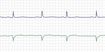 Electrocardiogram for MIT-BIH Supraventricular Arrhythmia, record 822