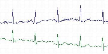 Electrocardiogram for MIT-BIH Supraventricular Arrhythmia, record 823