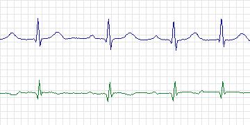 Electrocardiogram for MIT-BIH Supraventricular Arrhythmia, record 824