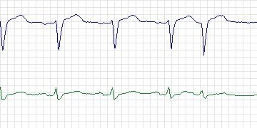 Electrocardiogram for MIT-BIH Supraventricular Arrhythmia, record 825