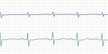 Electrocardiogram for MIT-BIH Supraventricular Arrhythmia, record 826