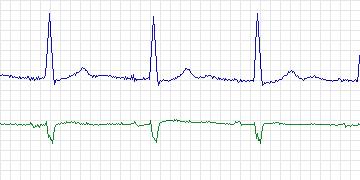 Electrocardiogram for MIT-BIH Supraventricular Arrhythmia, record 827